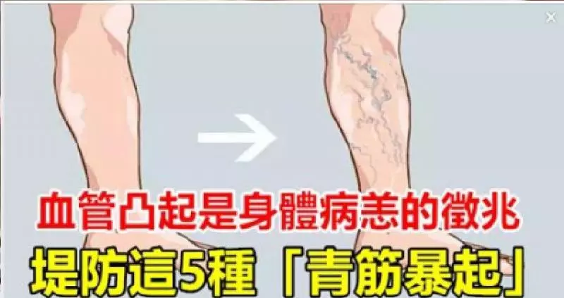 血管凸起是身體病恙的徵兆,堤防這5種「青筋暴起」!