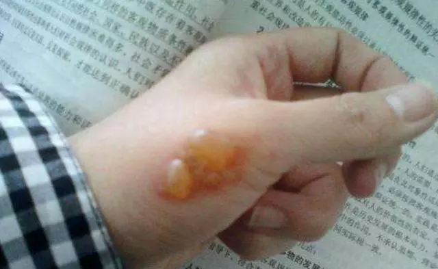 不小心被燙傷怎麼辦?別慌,教你一招,快速止痛不留疤
