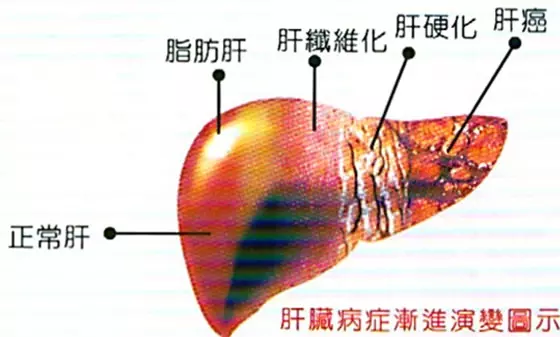 注意!容易疲勞的人是肝不好,教你一個「簡單小動作」把健康的肝養回來!