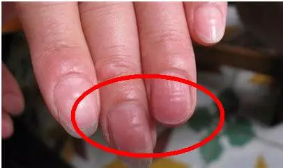 它是肝毒的「解毒王」 每天吃一點 肝炎、肝硬化不攻自破