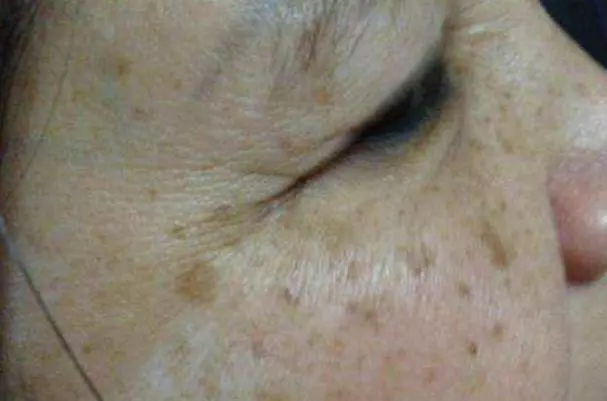 「它」是斑點皺紋的剋星,米醋加點它,老年斑、妊娠斑、雀斑、青春痘不見了好神奇