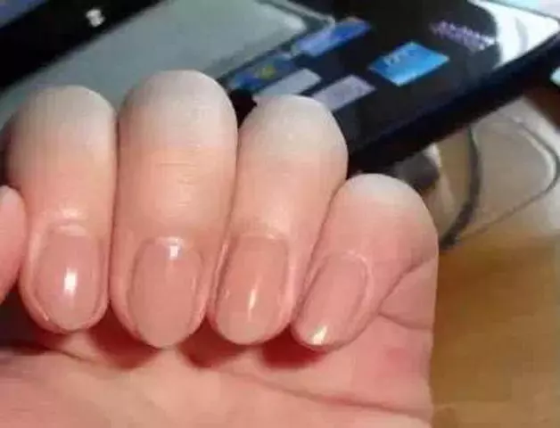 你的指甲上有一道道直線嗎?那你就要特別小心了!!可能是這種重大疾病的微兆…