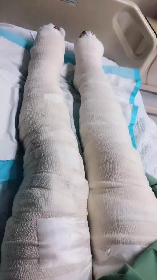 【Shereen火傷後 · 痛苦感言】漂亮女子遭男友「鞭打」和「淋油焚燒」!她表示:「我的一生已經毀了,我真的不想活了!