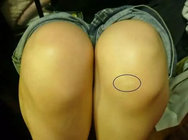 收藏!!讓膝蓋軟骨重生的方法:無需吃藥,又不用打針,每天只要10分鐘!