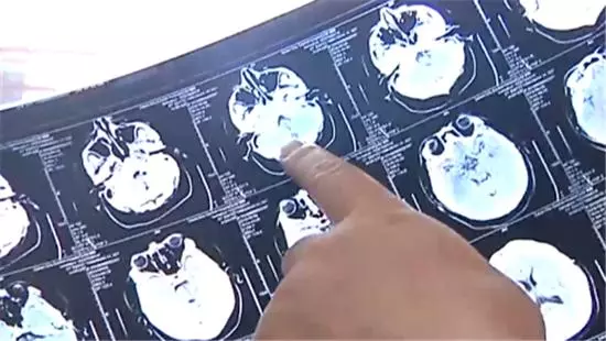 世界盃來了球迷狂歡 醫生熬夜看球易突發腦出血