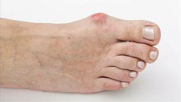 跑步、健走必看!常遇到的「腳丫十大病症」
