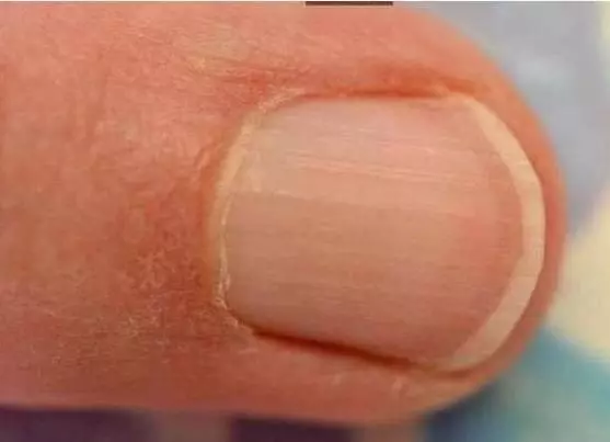 指甲上如果有這種直直的線,這是大病來的前兆!