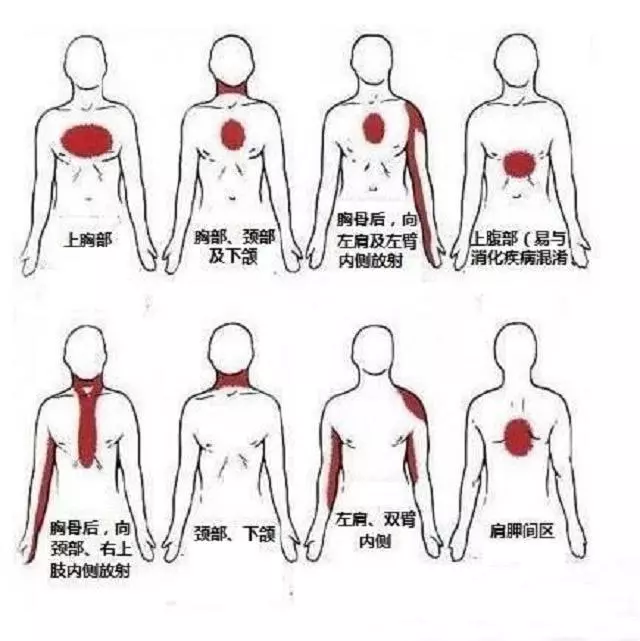 心肌梗死年輕化,如何預防