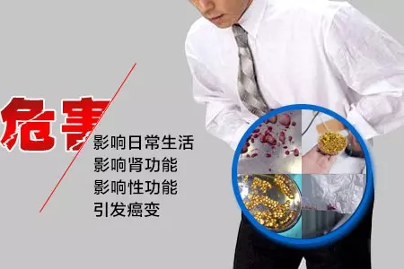 親身經歷,我的腎結石是這樣排出來的