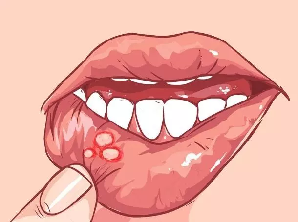 想口腔潰瘍少發作,吃什麼好?