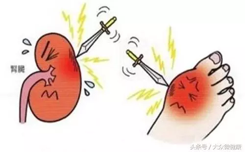 醫生揭秘:4個秘訣,讓尿酸會乖乖排出!痛風患者有福氣了!