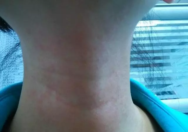 皮膚濕疹癢起來真要命,一招幫你擺脫濕疹,還你健康美麗!