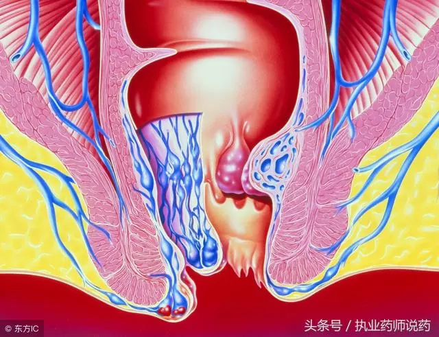 痔瘡的症狀有哪些?有痔瘡用什麼藥好?趕跑痔瘡不求人