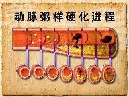 腦出血患者:莫讓"世界盃"變成「世界悲」