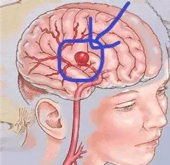 腦出血患者:莫讓"世界盃"變成「世界悲」