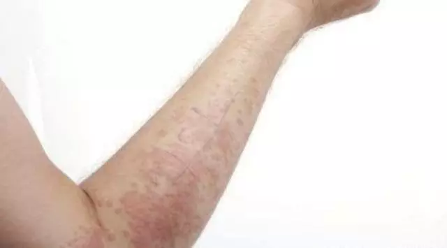 濕疹復發,奇癢難耐?對付濕疹要做好這四點