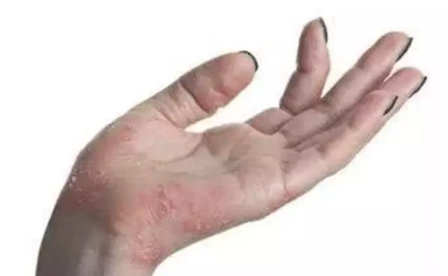 濕疹復發,奇癢難耐?對付濕疹要做好這四點