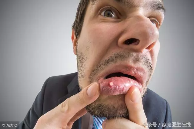 口腔潰瘍怎麼治?5個「小偏方」當天見效,拿走不謝!