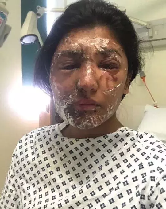 被硫酸毀容的女孩,一年後面容竟奇跡般復原了!