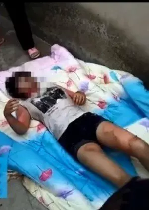 母親情敵破門捆綁雙腳 少女遭熱水灌嘴燒爛喉