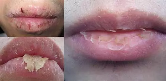 嘴唇時常乾裂的原因是什麼?