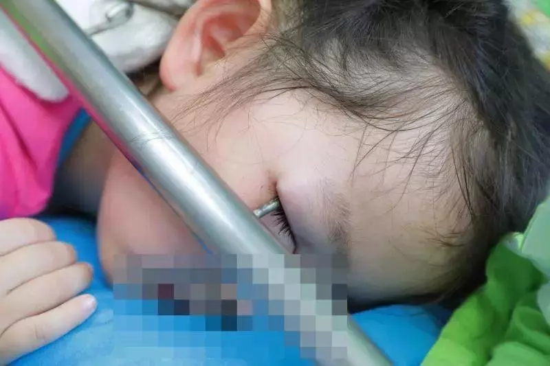 3歲女娃鐵鉤戳進眼睛,帶著一截鋼管送醫!這東西你家也有