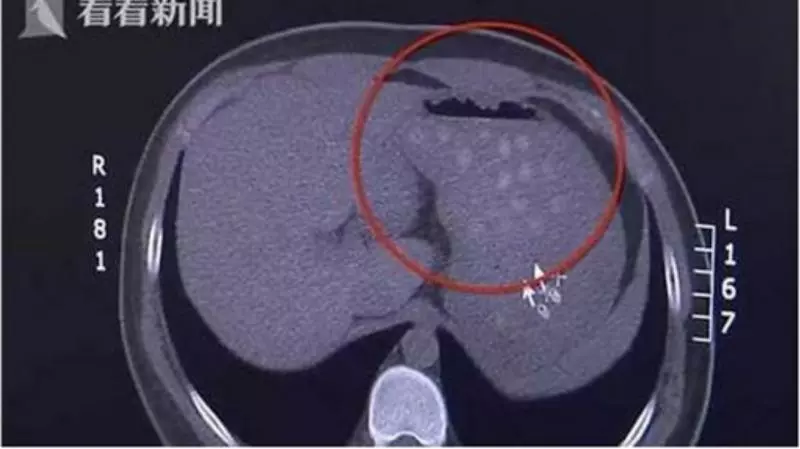連喝2杯珍奶 他腹痛就醫…驚見珍珠「堆成山