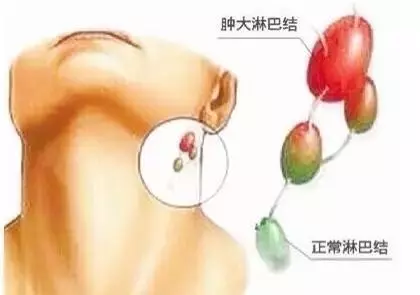 脖子長小肉粒!說明你身體出了問題!