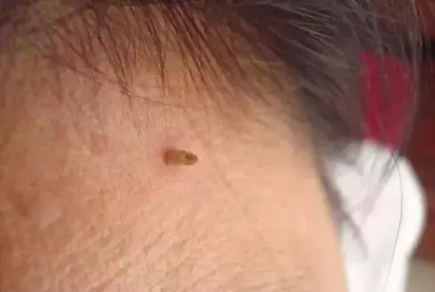 脖子長小肉粒!說明你身體出了問題!