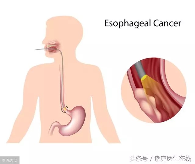 燙口的食物與食管癌,到底有什麼關係?給大家講清楚