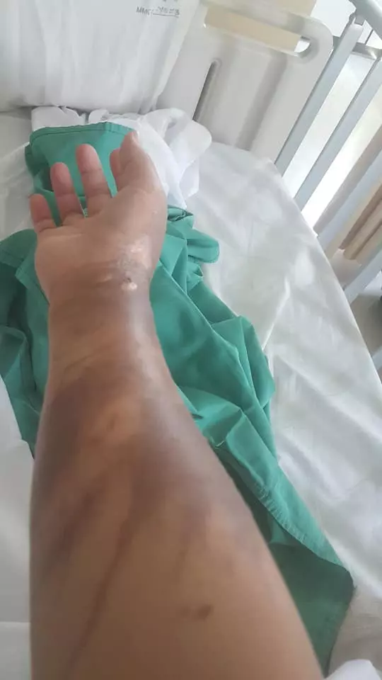 有血有淚的教訓! 大馬美少婦PO文: 第一次通洗碗盆, 想不到被「這一瓶」害慘了! 手腳都中招…