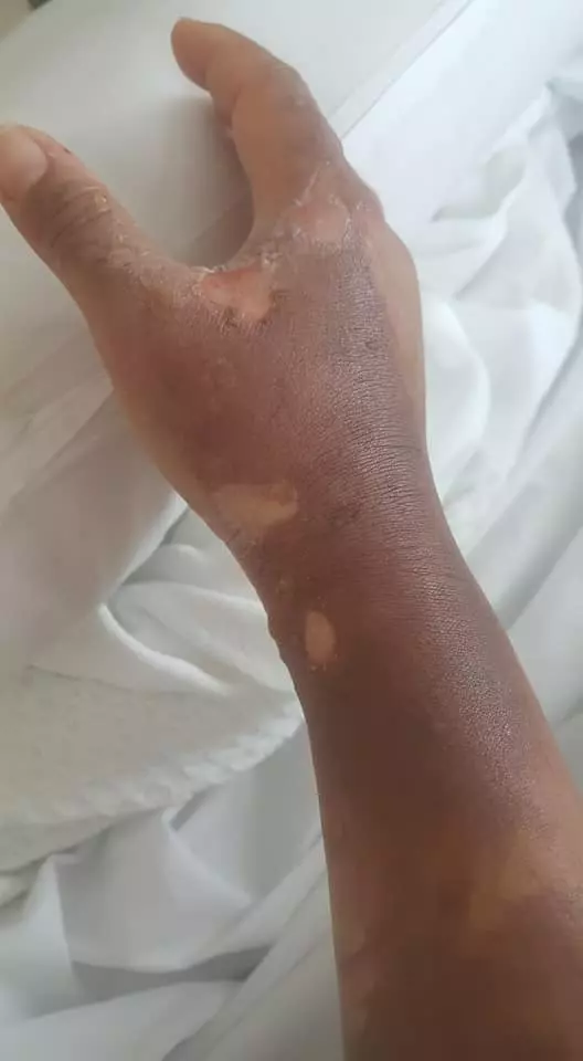 有血有淚的教訓! 大馬美少婦PO文: 第一次通洗碗盆, 想不到被「這一瓶」害慘了! 手腳都中招…