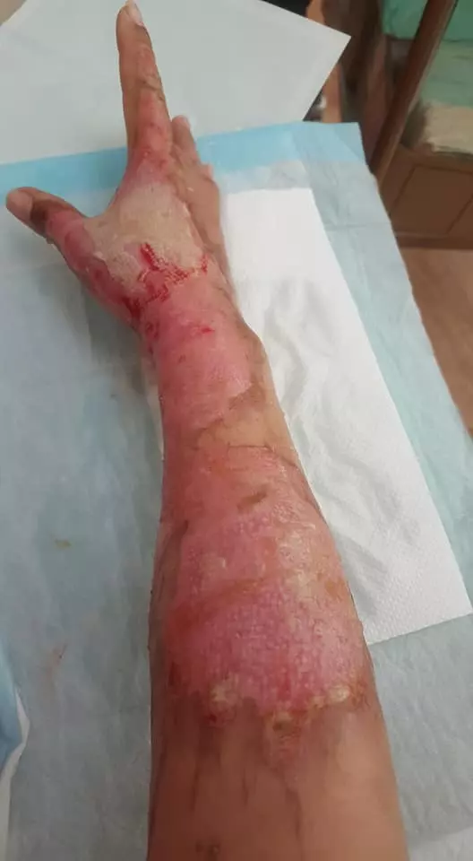 有血有淚的教訓! 大馬美少婦PO文: 第一次通洗碗盆, 想不到被「這一瓶」害慘了! 手腳都中招…