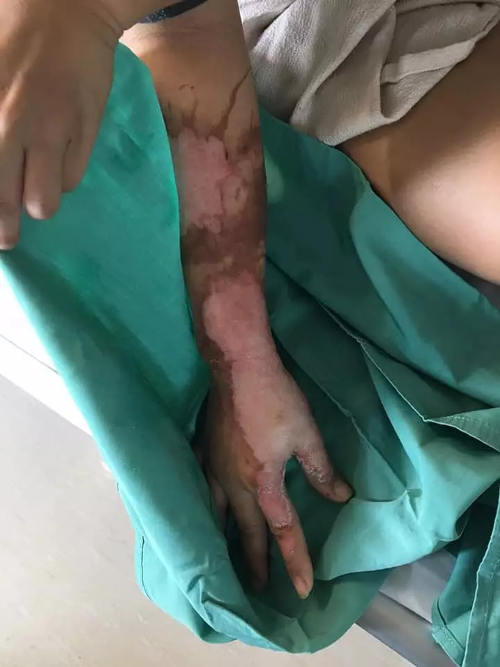 有血有淚的教訓! 大馬美少婦PO文: 第一次通洗碗盆, 想不到被「這一瓶」害慘了! 手腳都中招…