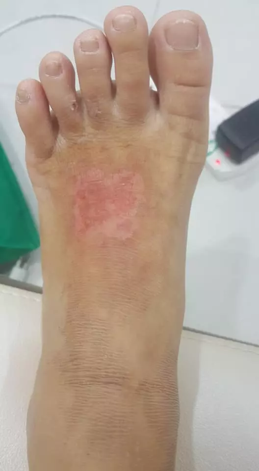 有血有淚的教訓! 大馬美少婦PO文: 第一次通洗碗盆, 想不到被「這一瓶」害慘了! 手腳都中招…