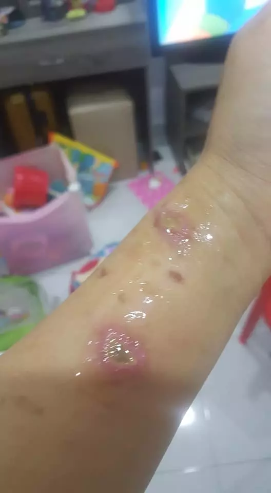 有血有淚的教訓! 大馬美少婦PO文: 第一次通洗碗盆, 想不到被「這一瓶」害慘了! 手腳都中招…