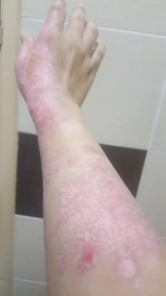 有血有淚的教訓! 大馬美少婦PO文: 第一次通洗碗盆, 想不到被「這一瓶」害慘了! 手腳都中招…