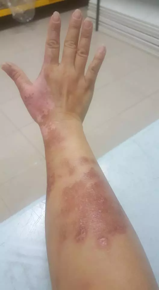 有血有淚的教訓! 大馬美少婦PO文: 第一次通洗碗盆, 想不到被「這一瓶」害慘了! 手腳都中招…