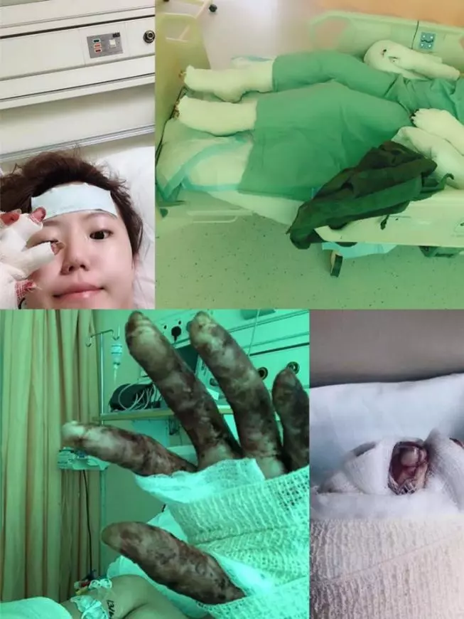 【全身被燒傷60%!】24歲正妹『被前男友放火燒』,急需捐款來動植皮手術!