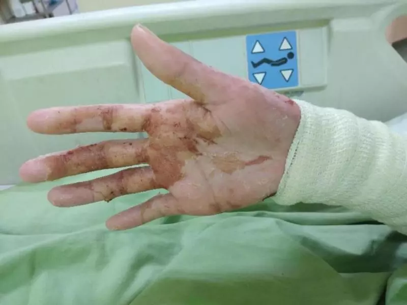 【全身被燒傷60%!】24歲正妹『被前男友放火燒』,急需捐款來動植皮手術!