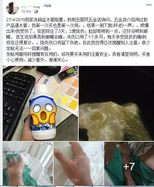 【大馬年輕媽媽親身經歷!!】第一次用『這瓶』來通洗手盆竟發生爆炸!全身嚴重被灼傷還留疤!