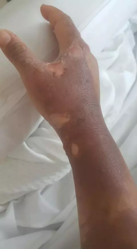 【大馬年輕媽媽親身經歷!!】第一次用『這瓶』來通洗手盆竟發生爆炸!全身嚴重被灼傷還留疤!