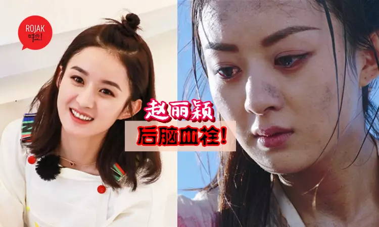 趙麗穎後腦血栓!剛開始不以為意, 看了醫生才知道嚴重性, 宣布停工不再接戲!