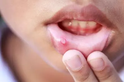 兒童傳染病手足口症HFMD如何預防?