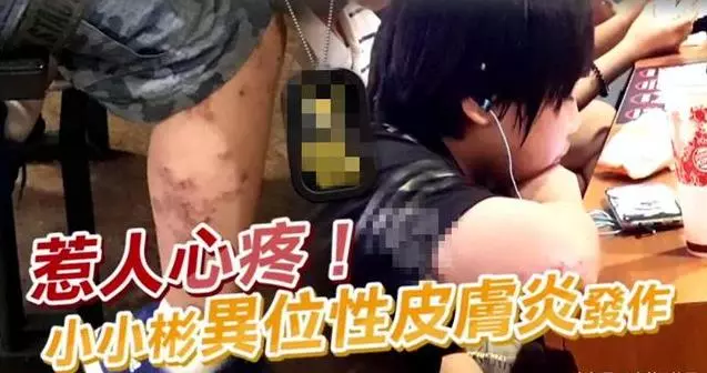 14歲小小彬被爸爸當搖錢樹來還房貸養全家!如今近照曝光,手腳潰爛令人心疼!