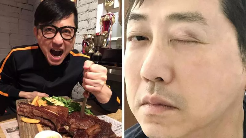 庾澄慶曝被家暴 右眼瘀青腫脹