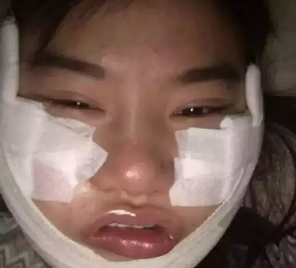 我想變楊冪:女粉砸450萬削骨整成楊冪,整容後全民跪了
