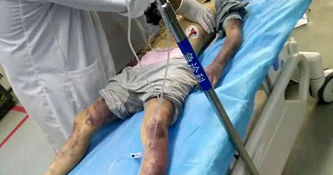 父鞭打1小時殺6歲女 醫師看了落淚