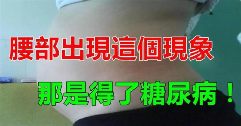 你的腰如果出現這個狀況,可能是患上了糖尿病