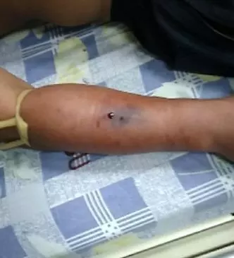 好奇想徒手抓蛇 男子被咬到險喪命